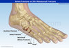 Jones-Fracture.jpg