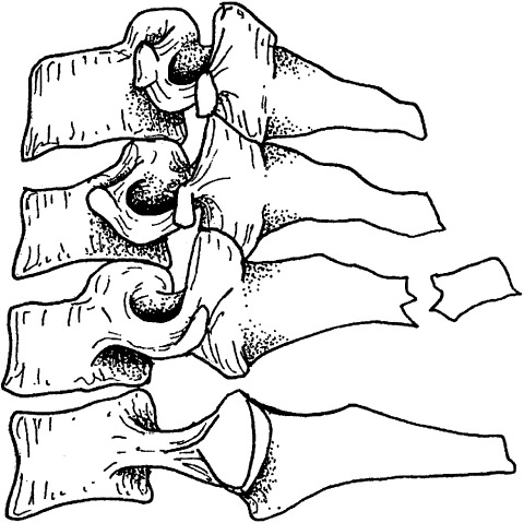 clay-shoveler-fracture.jpg