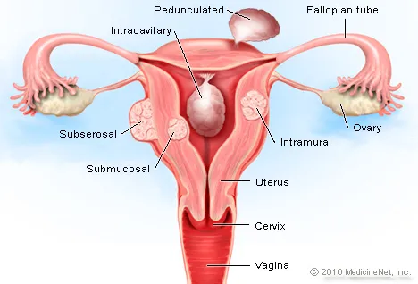 detail-uterine-fibroids.jpg