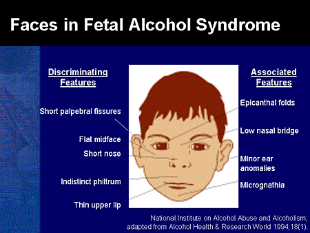 Fetal-Alcohol-Syndrome-faces.gif