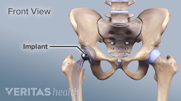 uncemented-replacement-hip-joint.jpeg