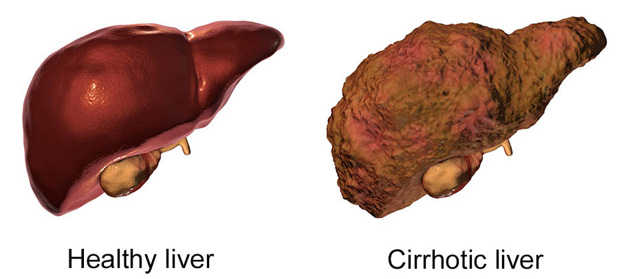 cirrhosis-liver-illustration-1b49f2.jpg