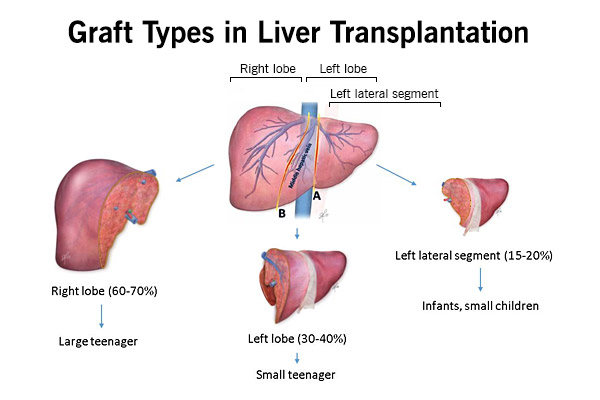 graft-types-liver-transplantation.ashx
