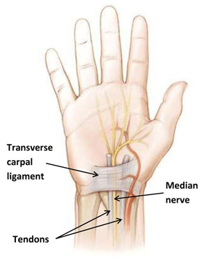 carpal-tunnel-syndrome-5609.jpg
